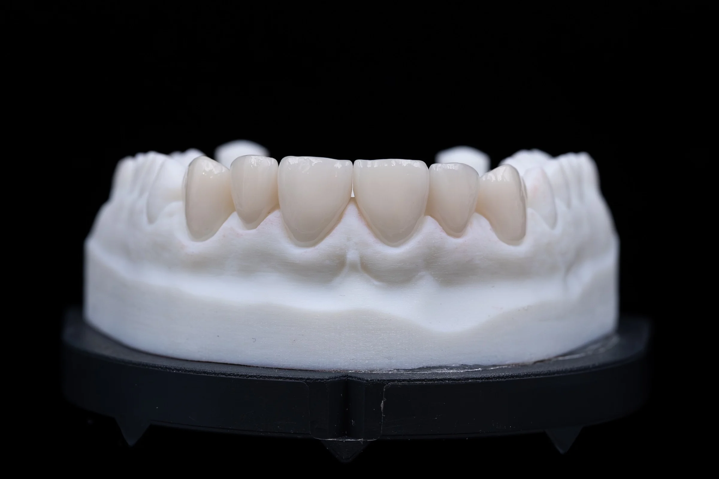 Keramische Veneers in der Frontalansicht auf einem Modell