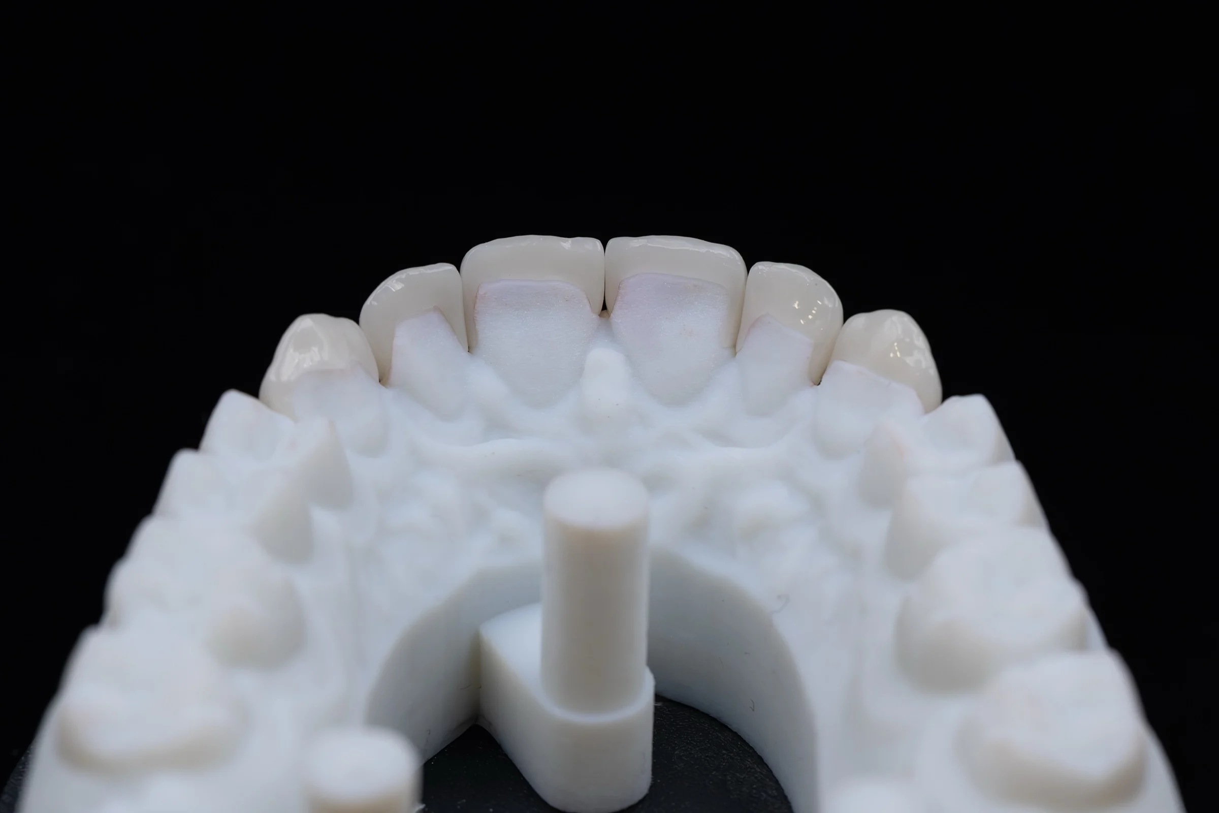 Keramische Veneers von der Innenseite auf einem Modell